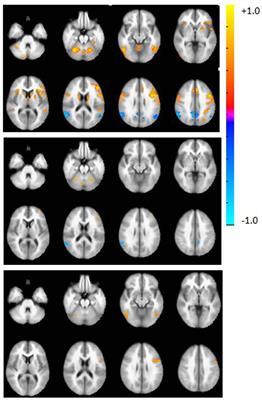 Investigating the Blood Oxygenation Level-Dependent Functional MRI Response to a Verbal Fluency Task in Early Stroke before and after Hemodynamic Scaling